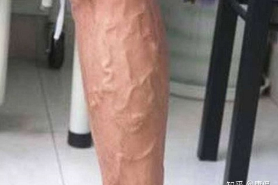 如果你有“蚯蚓腿”，教你两招对付它