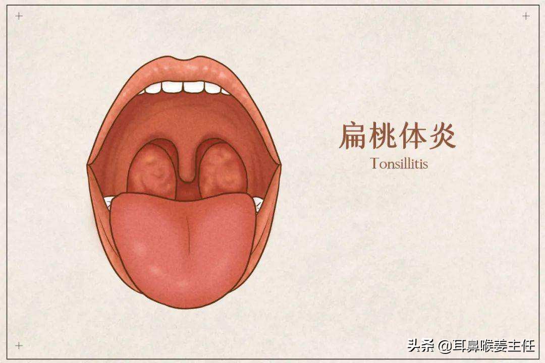 扁桃体发炎了怎么办，需要注意哪些方面呢？