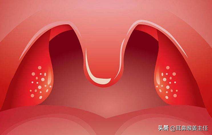 扁桃体发炎了怎么办，需要注意哪些方面呢？