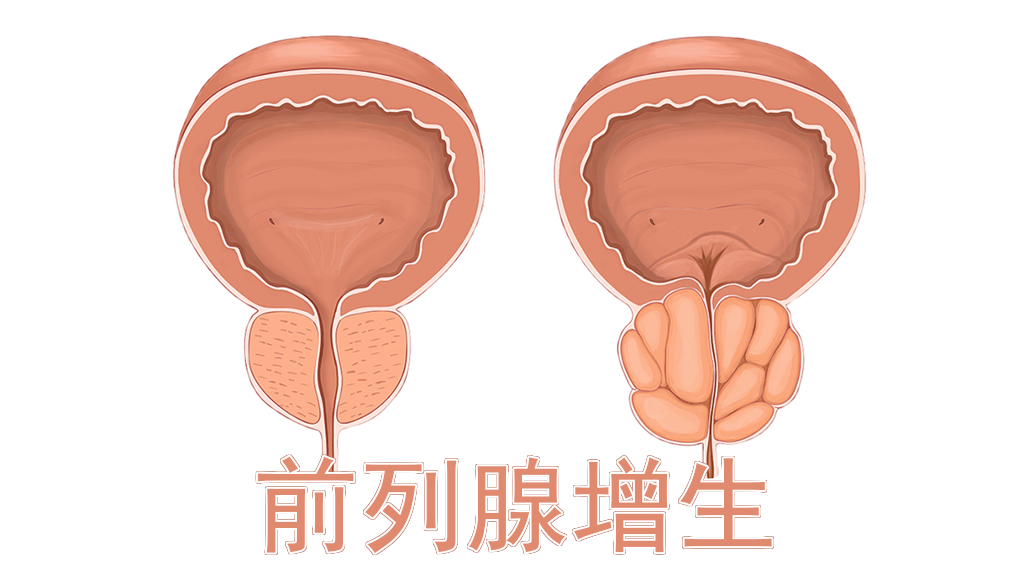 尿频尿急早泄=肾虚？“前列腺”表示不同意