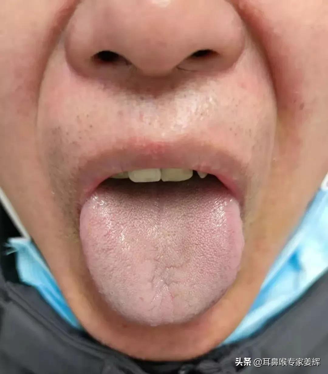过敏性鼻炎的中医疗法