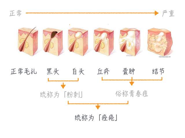 痤疮治疗，临床常用抗生素——米诺环素，一文解析