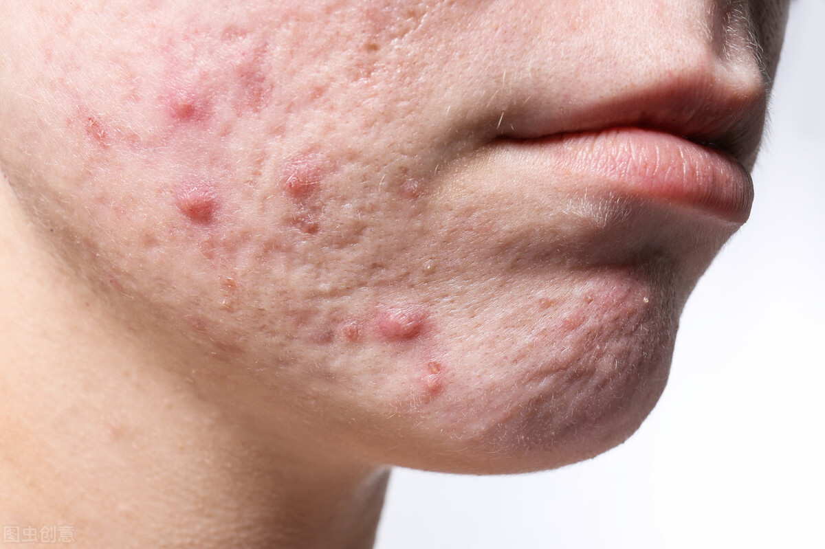 痘痘、闭口反反复复？搞定痘痘，这6种药不能少