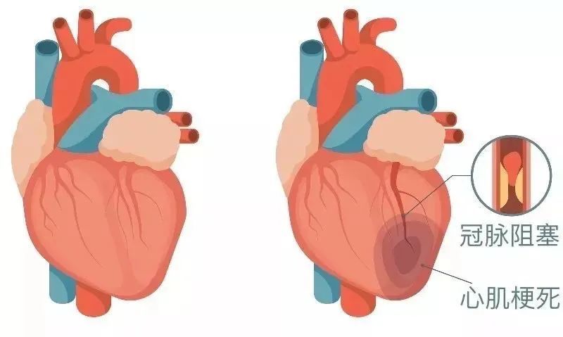 90后小伙心梗拒绝手术，医生：年轻人心梗，比老年人猝死风险更高