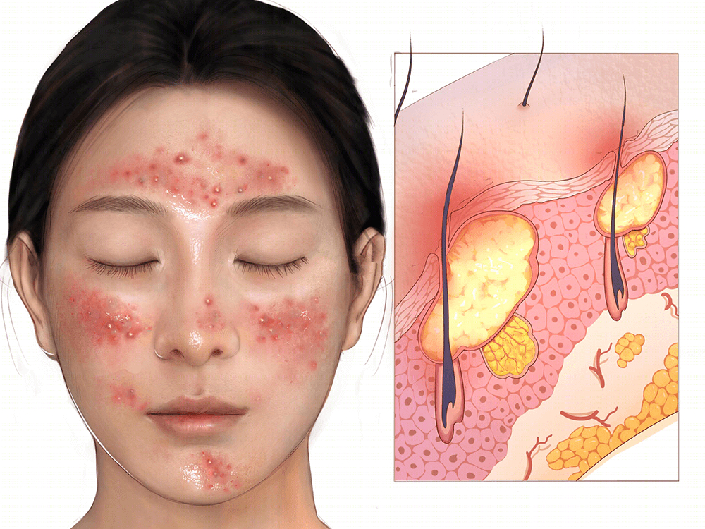 痘痘、闭口反反复复？搞定痘痘，这6种药不能少
