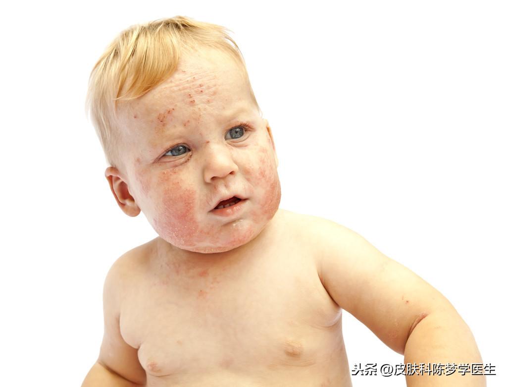 治疗湿疹的中成药（3类外治湿疹的中成药）