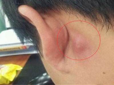 耳朵后面长疙瘩是什么原因