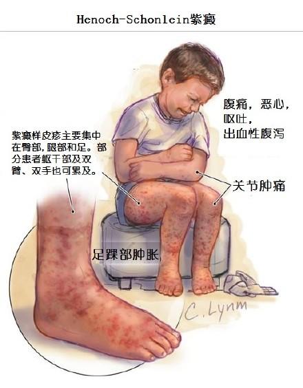 过敏性紫癜用什么药（西药、中成药及中药方剂）
