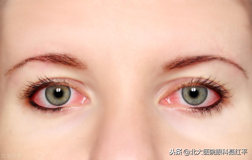 红眼病怎么传染，红眼病怎么治疗