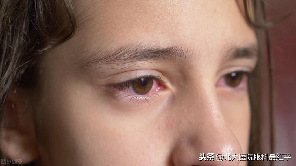 红眼病怎么传染，红眼病怎么治疗