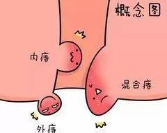 痔疮都有什么症状，痔疮的六大症状