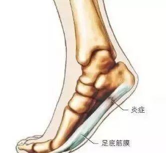 脚掌疼是怎么回事，几种常见的足底疼痛