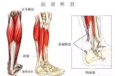 脚掌疼是怎么回事，几种常见的足底疼痛