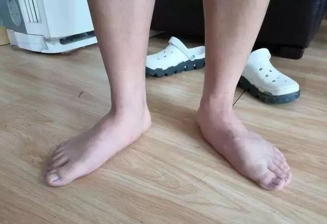 脚掌疼是怎么回事，几种常见的足底疼痛