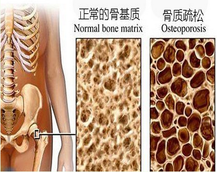 骨质疏松的治疗，怎么预防治疗骨质疏松