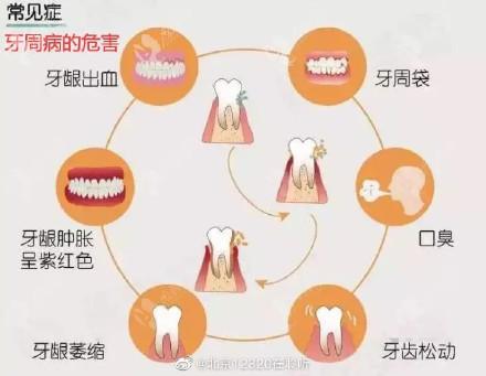 牙周炎的症状表现，注意这4个方面