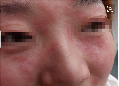 皮肤过敏吃什么药（常用药及联合用药）