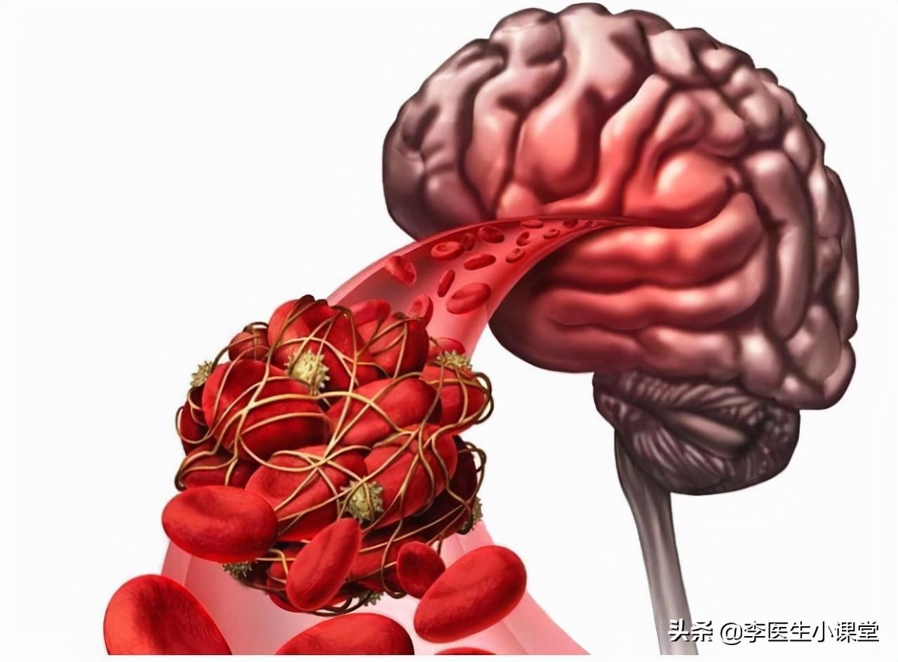 脑供血不足吃什么药效果最好