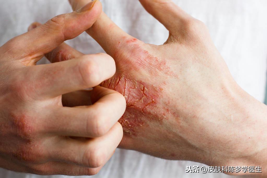 治疗湿疹的中成药（3类外治湿疹的中成药）