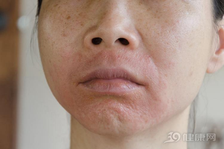 脸上过敏发红怎么办，如何预防颜面再发性皮炎？