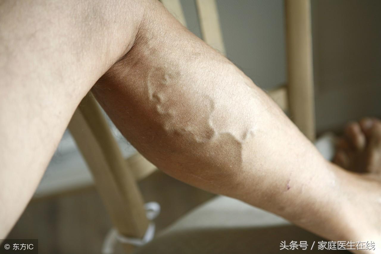 静脉曲张怎么治，主要有这2种方式