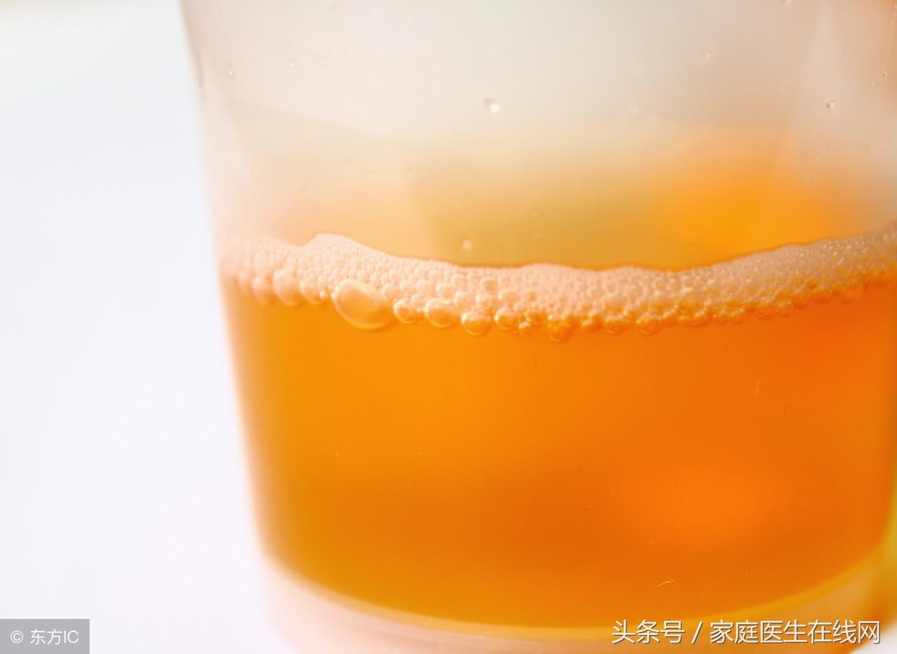 尿黄是什么原因，尿黄的原因主要有两种