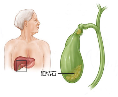 胆结石怎么消除，要不要切胆？