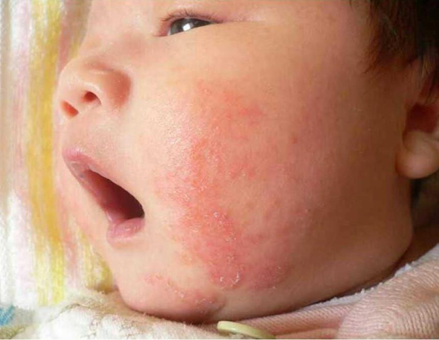 新生儿湿疹用什么药，常用于婴幼儿湿疹的五类药物