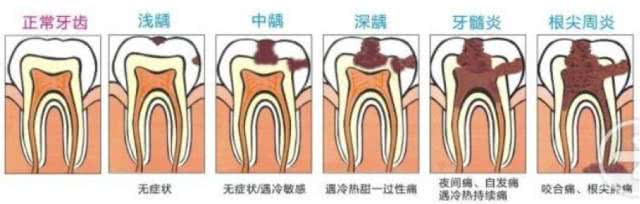 牙神经痛怎么办，不同的病因对症下药