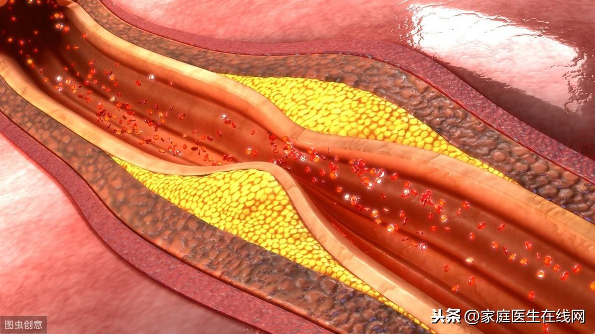 什么原因会导致心肌缺血？心肌缺血怎么办