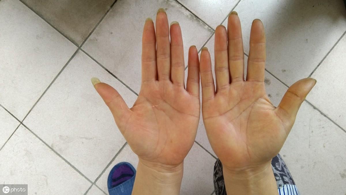 脚心出汗是怎么回事，多是这3种原因