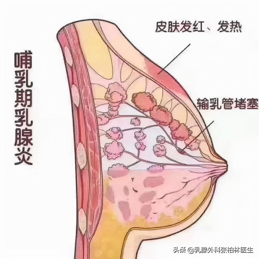 急性乳腺炎吃什么药，乳腺管阻塞一定会导致乳腺炎吗