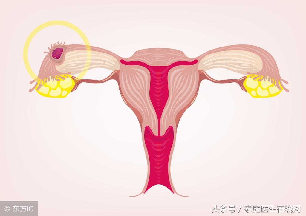 宫外孕怎么办，宫外孕一定要切除输卵管吗？