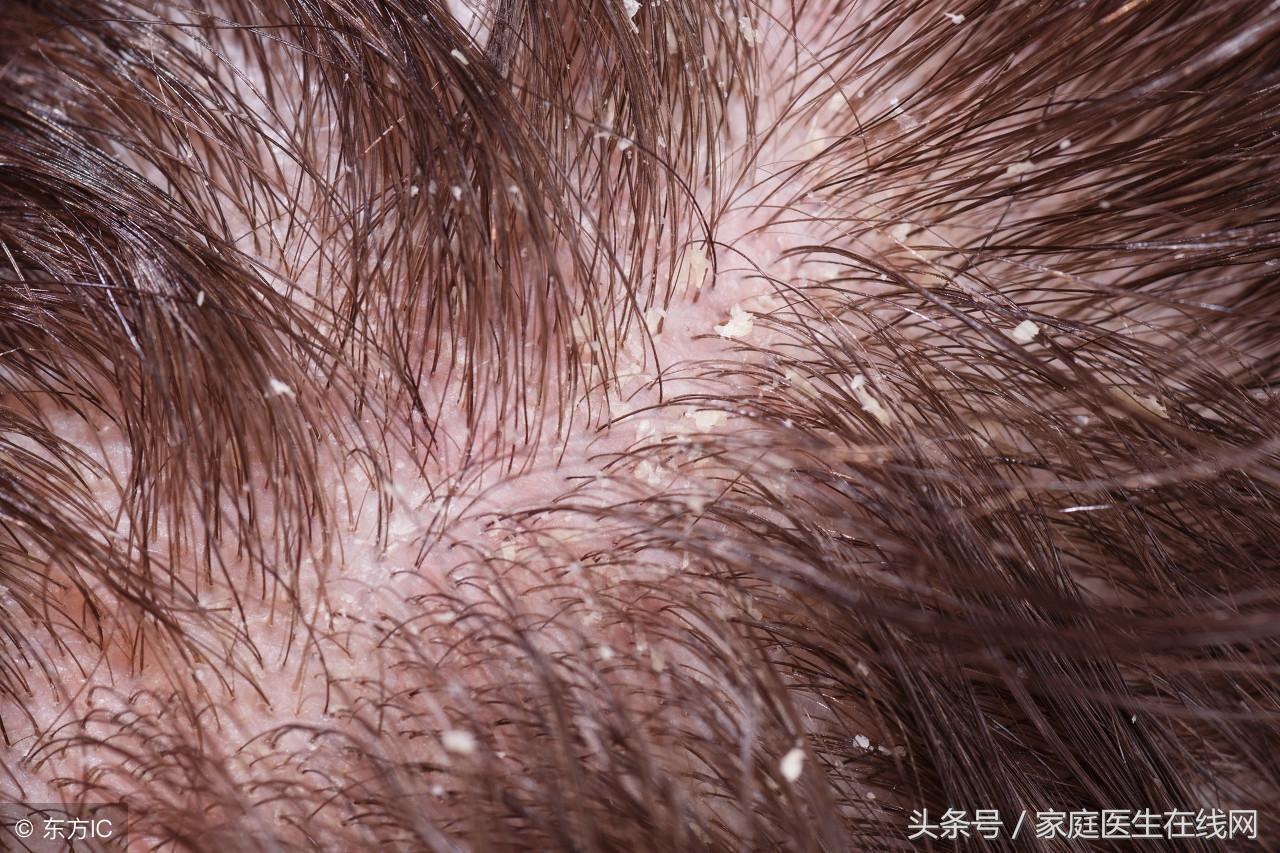 头皮屑怎么治，用这4个方法帮你解决