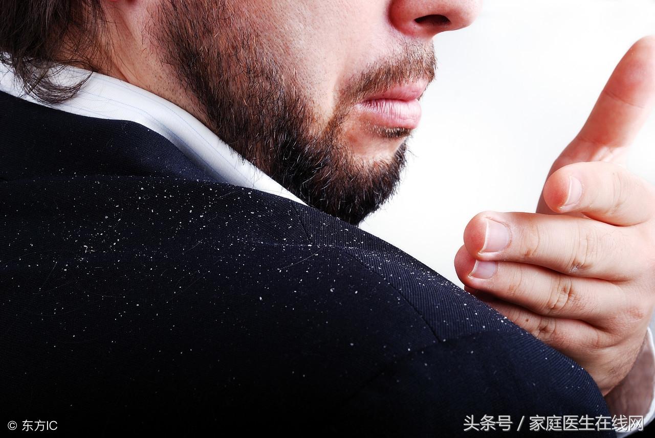 头皮屑怎么治，用这4个方法帮你解决