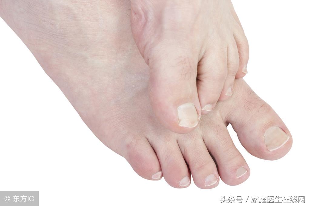 鸡眼的治疗方法，这5个“土方法”解决问题
