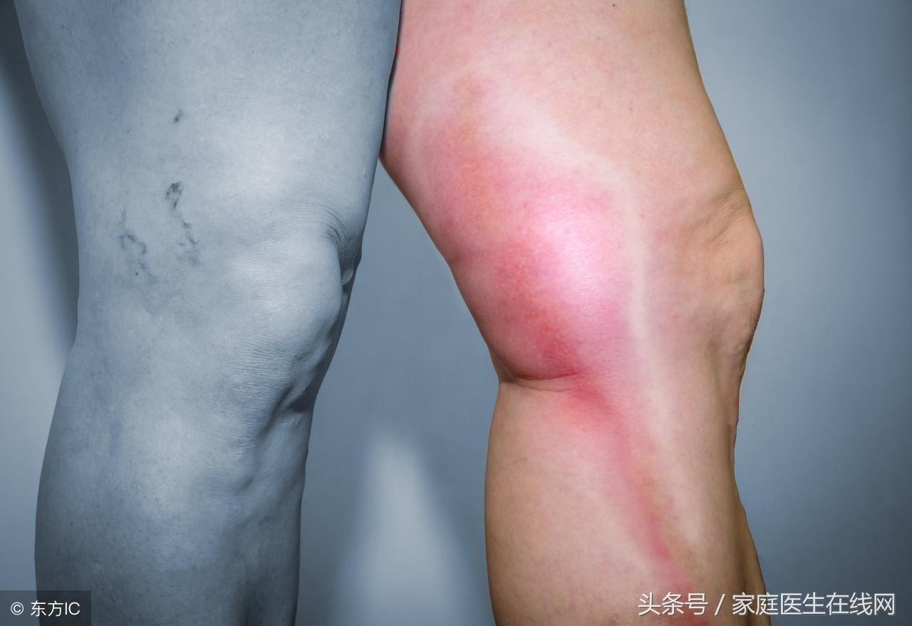 血栓并发症有哪些，血栓的饮食注意事项