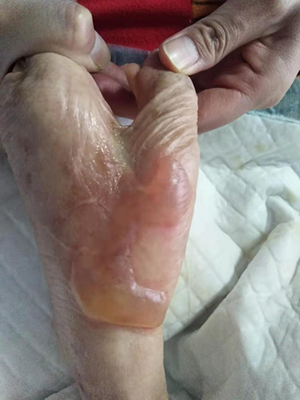 烫伤起泡怎么办，水泡挑破后的几种处理措施