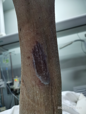 烫伤起泡怎么办，水泡挑破后的几种处理措施