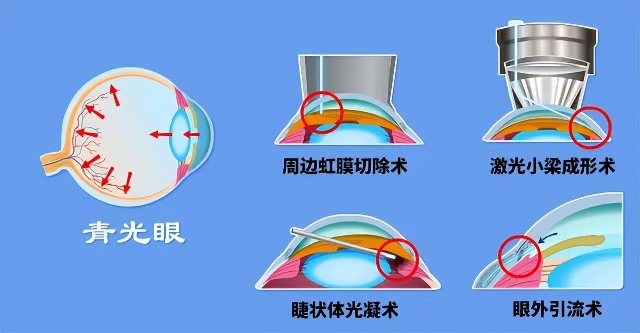 青光眼能治好吗，青光眼如何治疗？