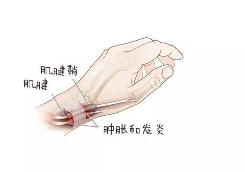 月子病有哪些，带你识别最常见的六种月子病