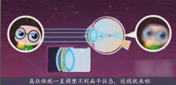 假性近视怎么办，教你几个小妙招