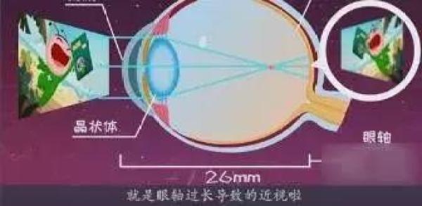 假性近视怎么办，教你几个小妙招