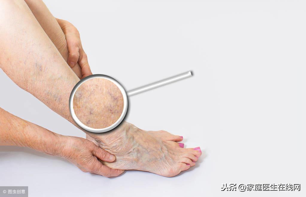 静脉曲张怎么办，医生建议你做4件事