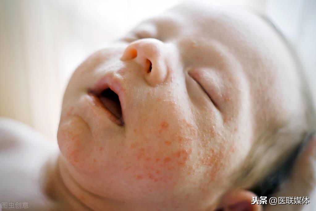 新生儿湿疹怎么治，用这4招来搞定