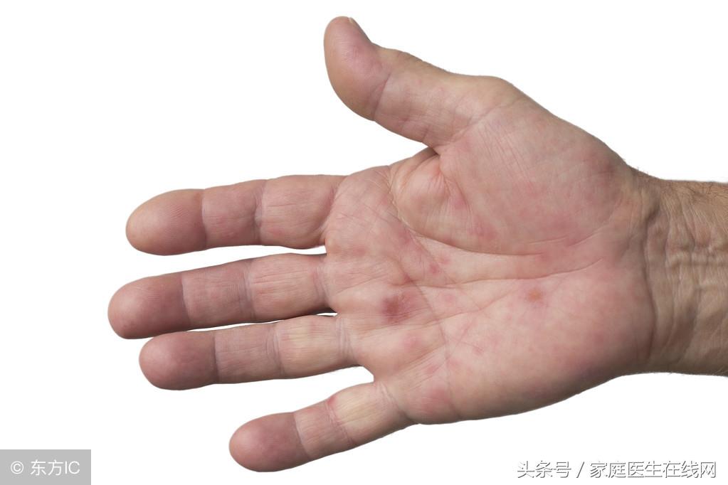 手足口病症状，会有这4个典型症状出现