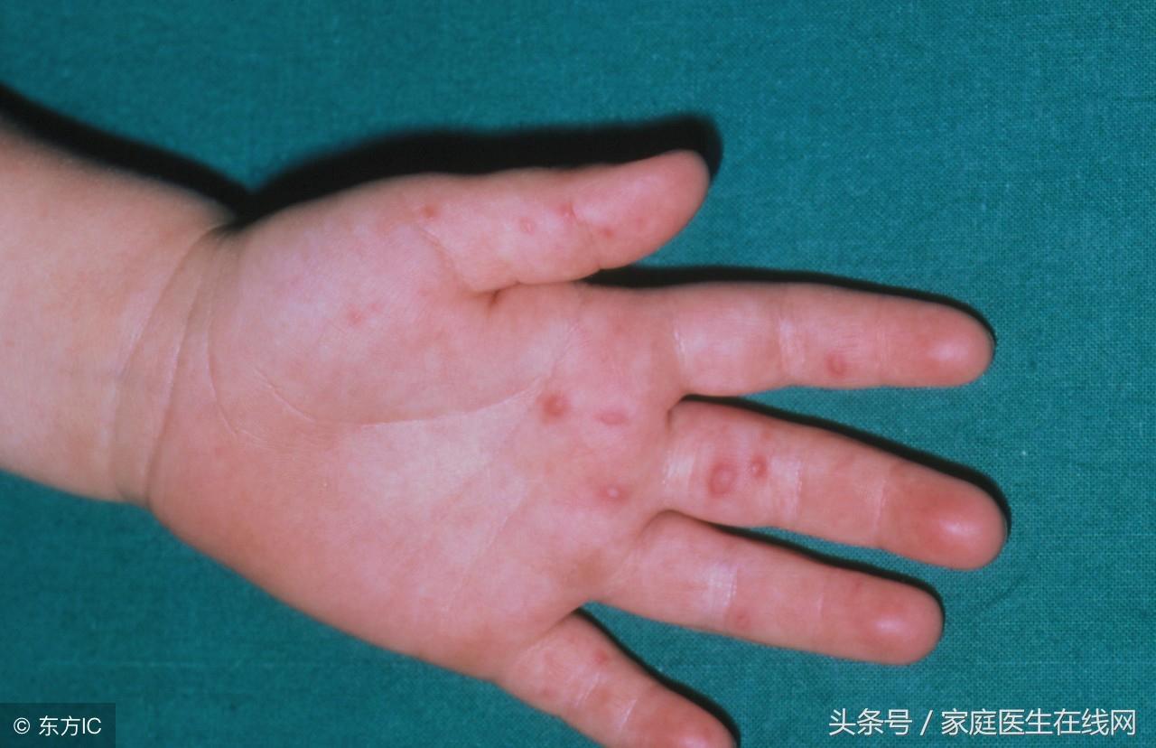 手足口病症状，会有这4个典型症状出现