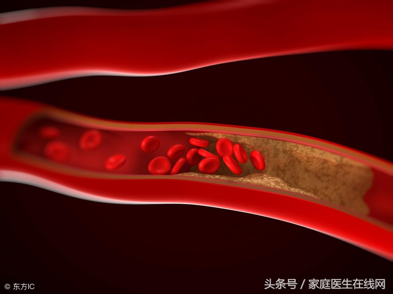 动脉硬化的原因，这4件事，是造成动脉硬化的“元凶”