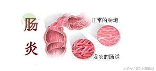 直肠炎的症状及治疗