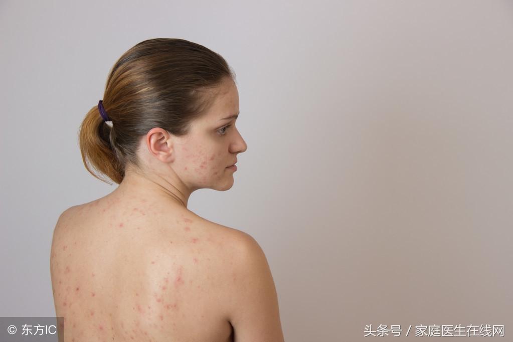 后背长痘痘怎么办，做好这4件事不发愁